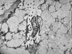 M,82y. | Helicobacter pylori - stomach